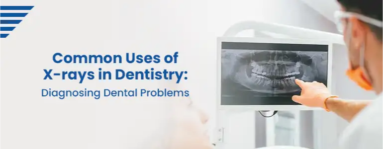 Common Uses of X-rays in Dentistry: Diagnosing Dental Problems