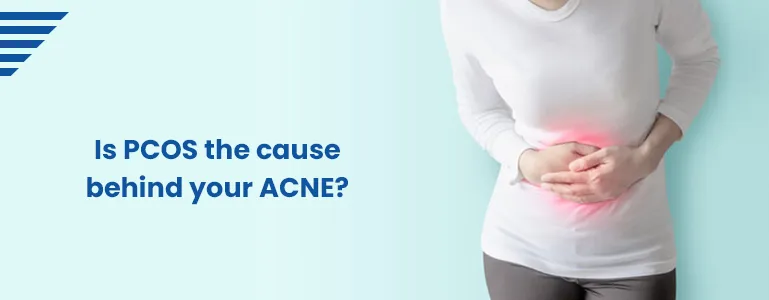 Is PCOS the cause behind your ACNE