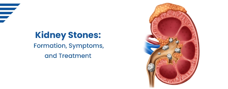 Kidney Stones: Formation, Symptoms, and Treatment