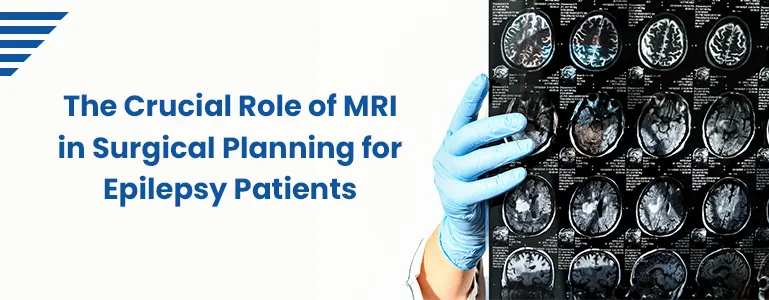 The Crucial Role of MRI in Surgical Planning for Epilepsy Patients