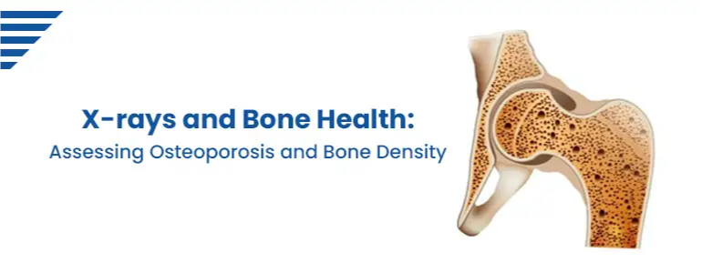 X-rays and Bone Health: Assessing Osteoporosis and Bone Density