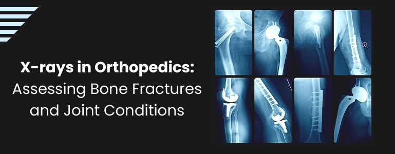 X-rays in Orthopedics: Assessing Bone Fractures and Joint Conditions