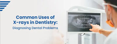 Common Uses of X-rays in Dentistry: Diagnosing Dental Problems