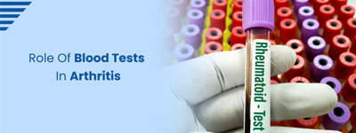 Role of Blood Tests in Arthritis