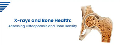 X-rays and Bone Health: Assessing Osteoporosis and Bone Density