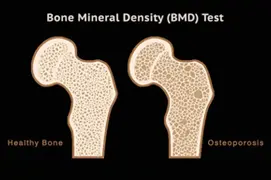 BMD (Bone Mineral Density) 