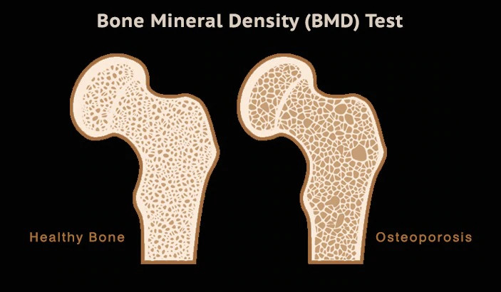 Bone Mineral Density (BMD)