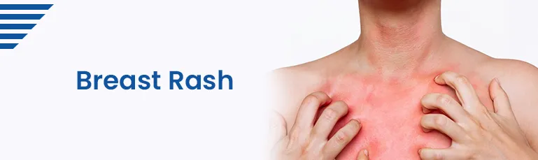 Breast rash - Symptoms, Causes, Treatments, and Prevention